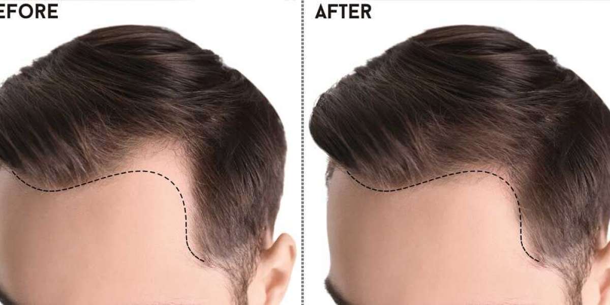 Hair Transplant in Pakistan: A Comprehensive Guide
