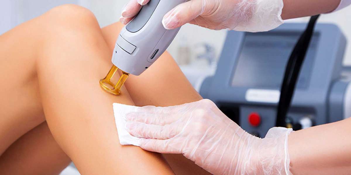 How Long Does Laser Hair Removal Take at Queen Aesthetics?