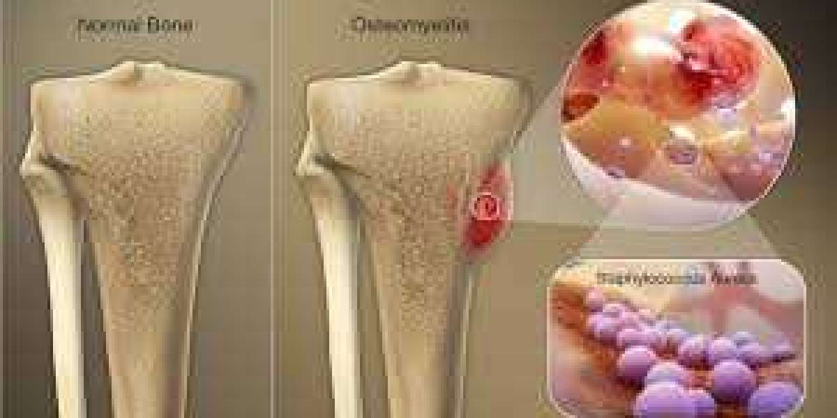 How to Find the Best Osteomyelitis Doctor and Choose the Right Treatment